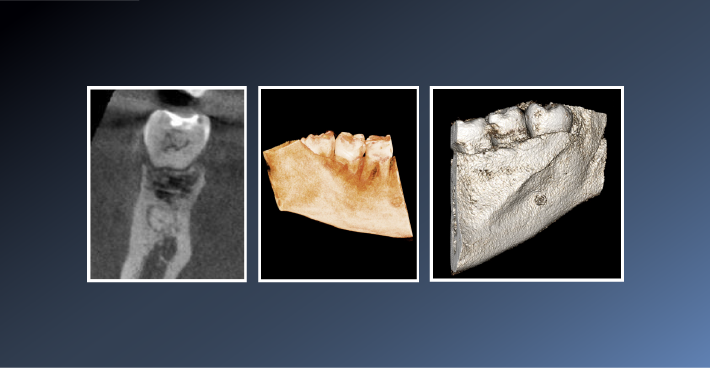 A well-defined radiolucency on CBCT – May 6, 2022