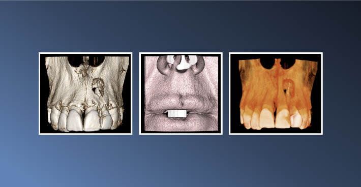An Endodontic Radiolucency – December 08, 2022