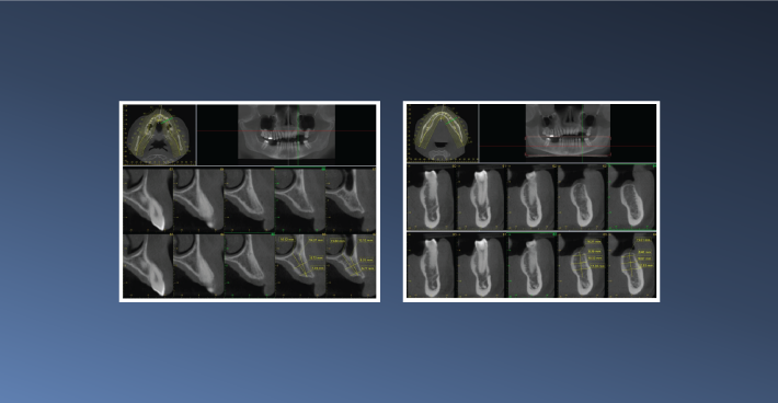 Implant Planning in Both Jaws – May 22, 2023