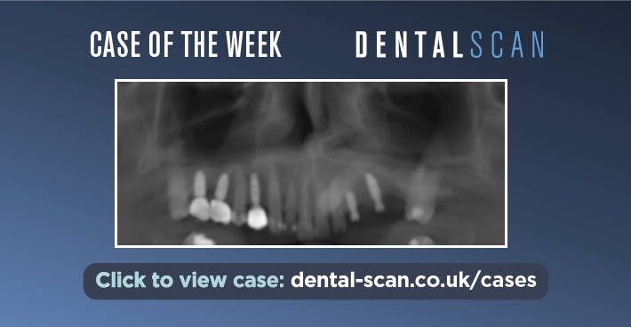 Case of the Week – Implant and Canine Collision