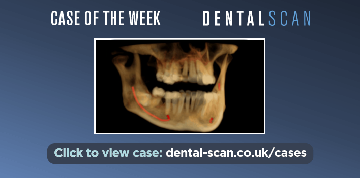 Case of the Week – Deeply Impacted Lower Third Molars