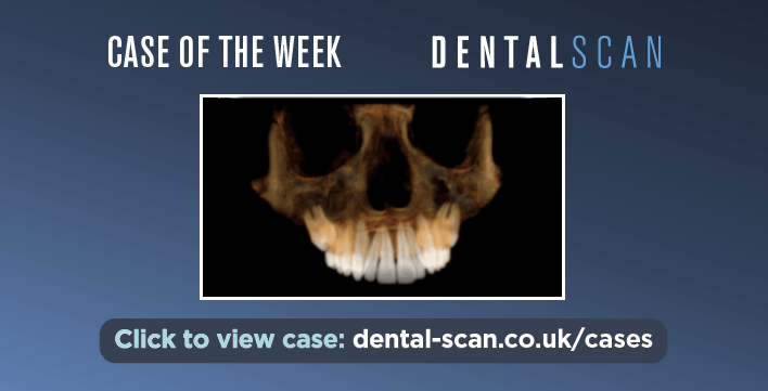 Case of the Week -Bilateral Unerupted Upper 2nd and 3rd Molars