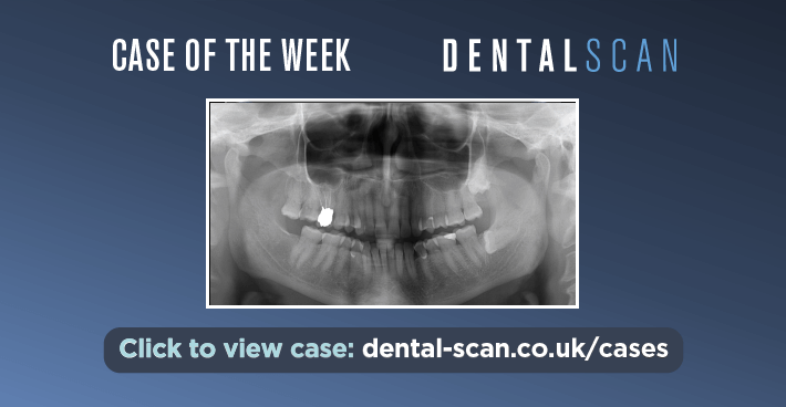 Case Of The Week – CBCT and Biopsy Advised – May 21,…